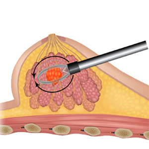 Neocision Illustration 3