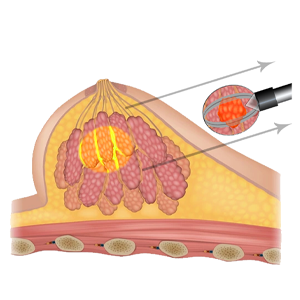 Neocision Illustration 4